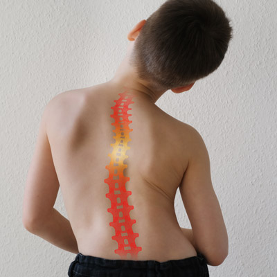 Can scoliosis adolescents be reversed Can scoliosis adolescents be reversed